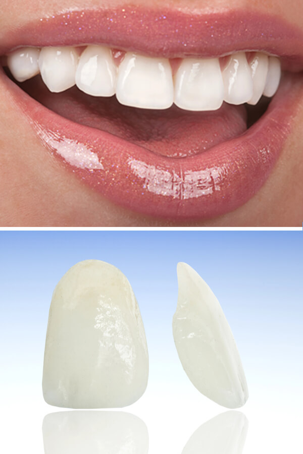 trattamento estetico dei denti