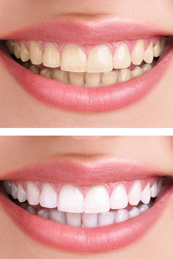 trattamento estetico dei denti