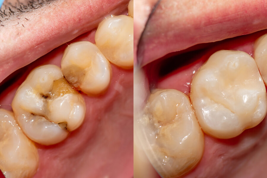prima e dopo una cura dal dentista de pace